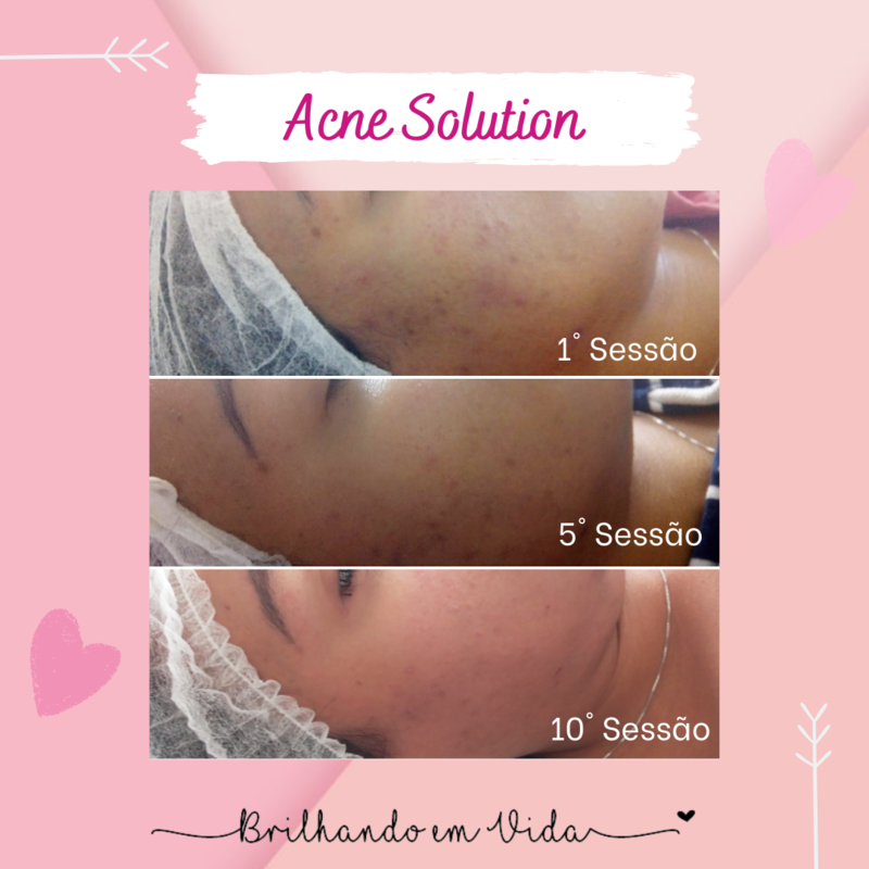 Peeling Químico para tratamento de Acne. 
Foram realizadas 10 sessões com o Kit Perfect Peel da linha Bioage. 
 2 Sessões de limpeza de pele durante o tratamento.  estética esteticista assistente esteticista
