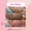Peeling Químico para tratamento de Acne. 
Foram realizadas 10 sessões com o Kit Perfect Peel da linha Bioage. 
 2 Sessões de limpeza de pele durante o tratamento. 