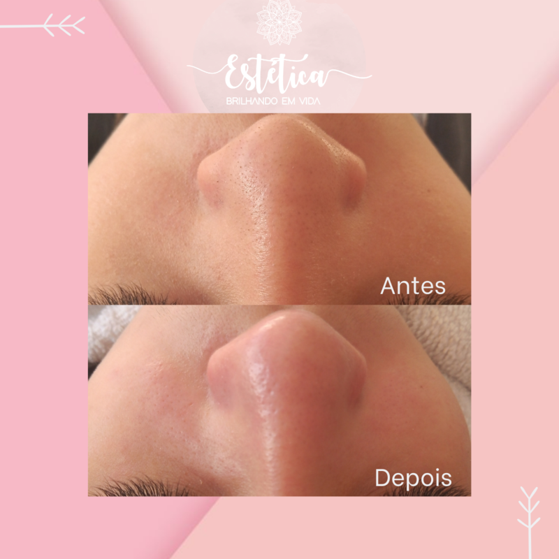 Limpeza de Pele. 
1 sessão. estética esteticista assistente esteticista