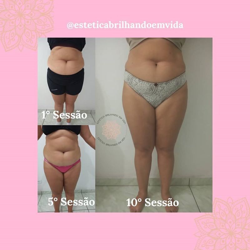 10 sessões de Drenagem Linfática+ Massagem Modeladora. estética esteticista assistente esteticista