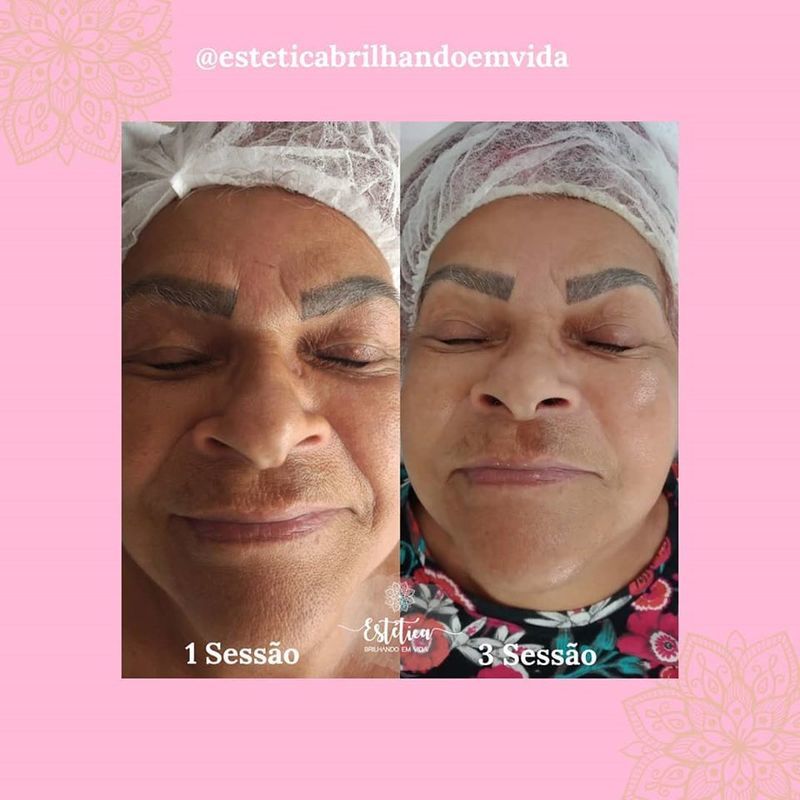 4 sessões de Peeling Químico para clareamento.  estética esteticista assistente esteticista