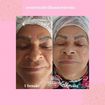 4 sessões de Peeling Químico para clareamento. 
