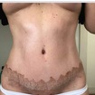 Abdominoplastia +lipo = 10 sessoes +apl Ultrasom Quadrante.

Paciente super satisfeita