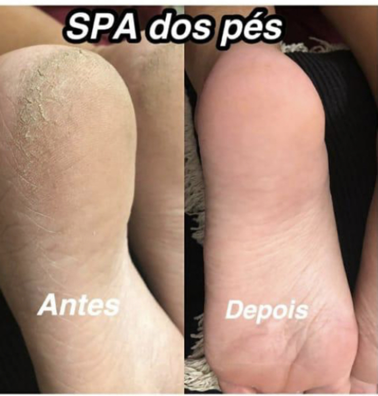 Spa dos pés 
Remoção de calosidade 
Lixamento 
Esfoliação 
Hidratação  unha manicure e pedicure
