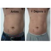 Aplicação de enzimas com caneta pressurizada, apenas 5 sessões. 