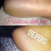 Plastica dos pés 