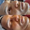 Tratamento microagulhamento - 1a sessão

#microagulhamento
#facial
#estetica