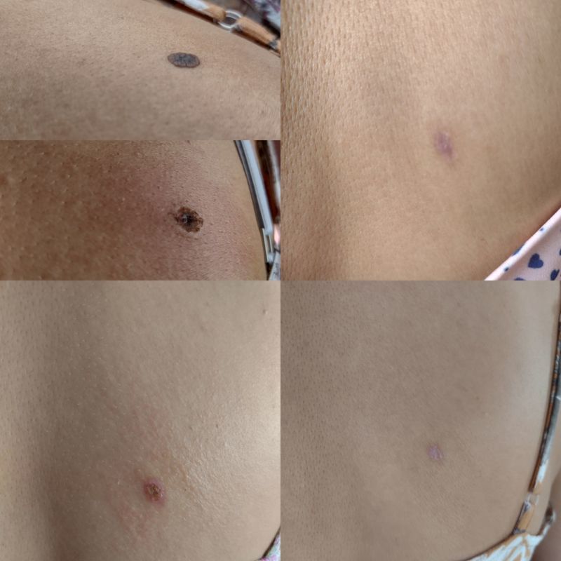 Extração de verruga etapas em 15 dias

#verruga
#extracao estética esteticista dermopigmentador(a) designer de sobrancelhas micropigmentador(a)