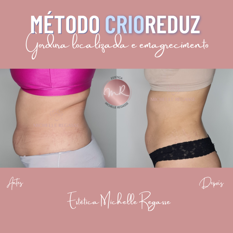 Método CrioReduz para gordura localizada e emagrecimento. 

#crio estética 